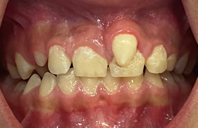 牙齒基因異常基因檢測