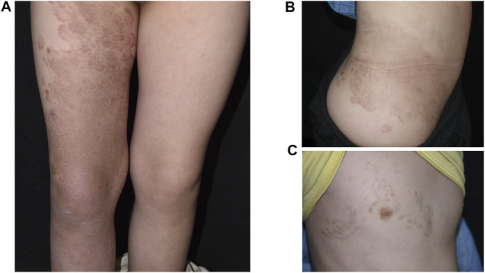 變異性紅斑角化癥