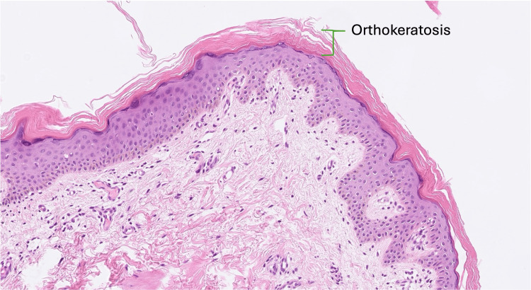 圖3. 魚(yú)鱗病皮膚活檢的組織病理學(xué)。
