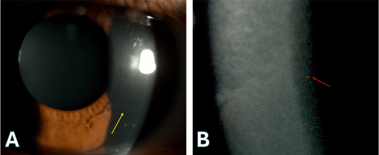 圖2. 明顯的角膜神經(jīng)和點(diǎn)狀深層基質(zhì)混濁。