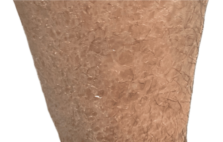 圖1：圖1. 下肢出現(xiàn)多邊形、暗色、鱗狀斑塊伴增厚斑塊。